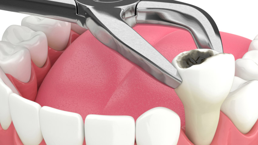 Tooth Extractions Service in Delhi