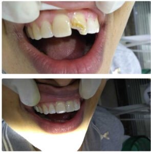 Composite Build-Up - Dr. Ankita Jindal