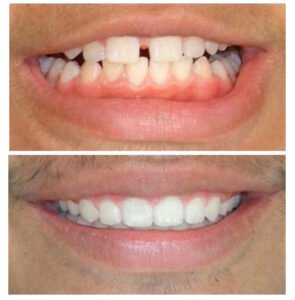 Smile via Veneers - Dr. Ankita Jindal
