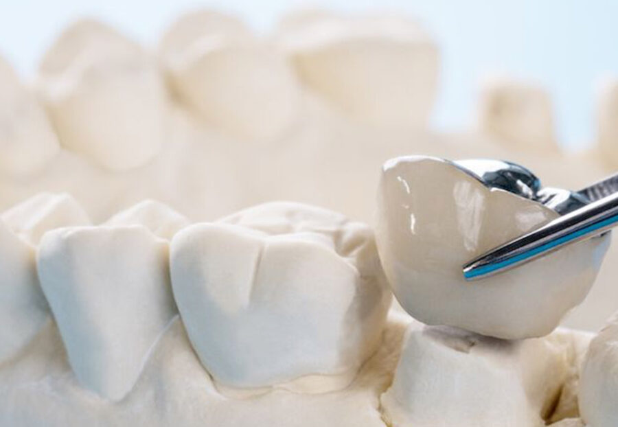 WHY IS CROWN OR CAP ESSENTIAL AFTER ROOT CANAL THERAPY