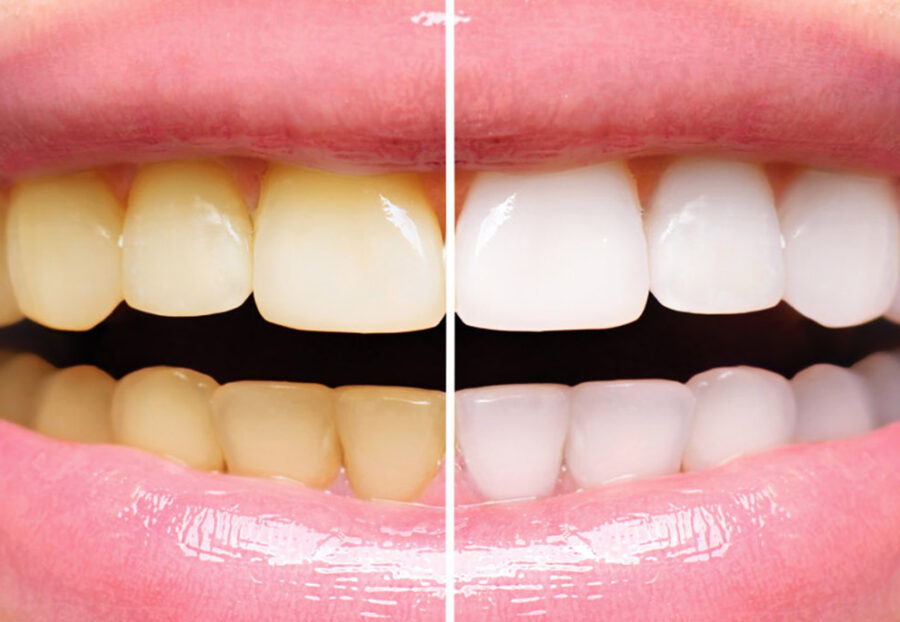 How to maintain healthy and white teeth