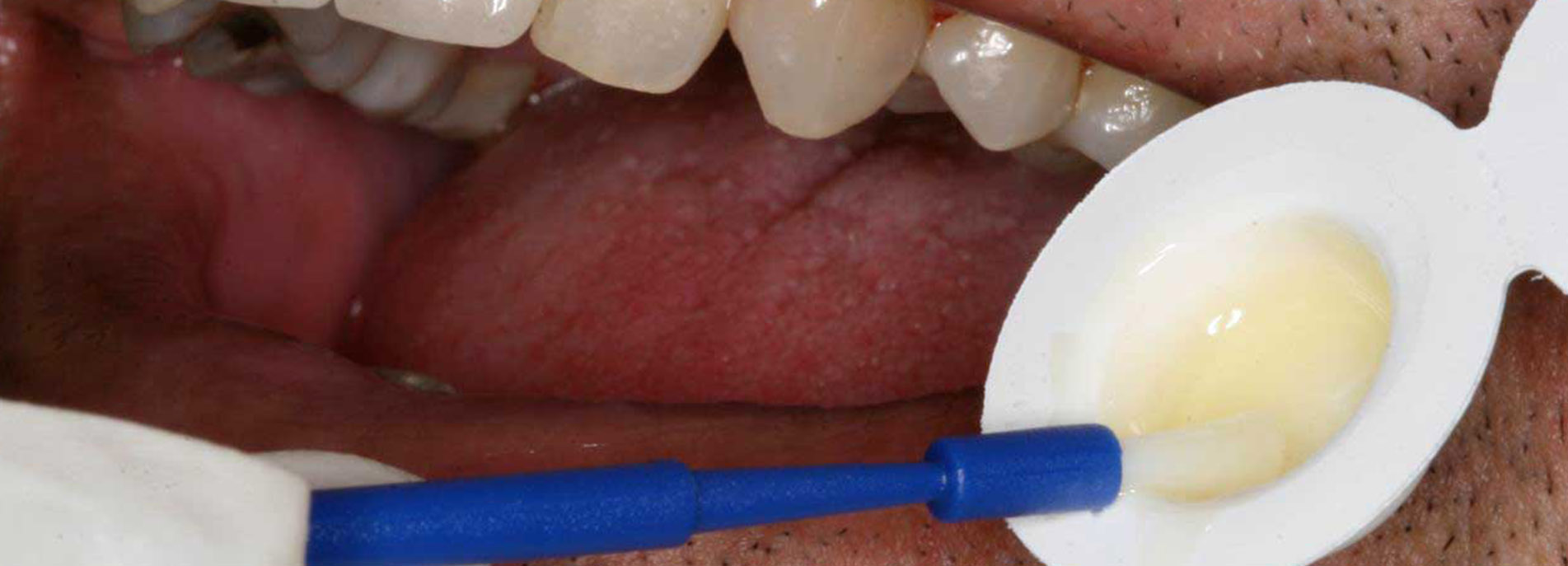 Teeth Fluoride Therapy in Dentistry in delhi