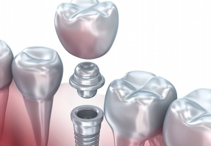 dental implants in north delhi