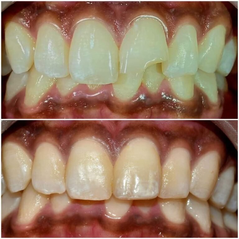 Aesthetic Filling - Dr. Ankita Jindal Poddar