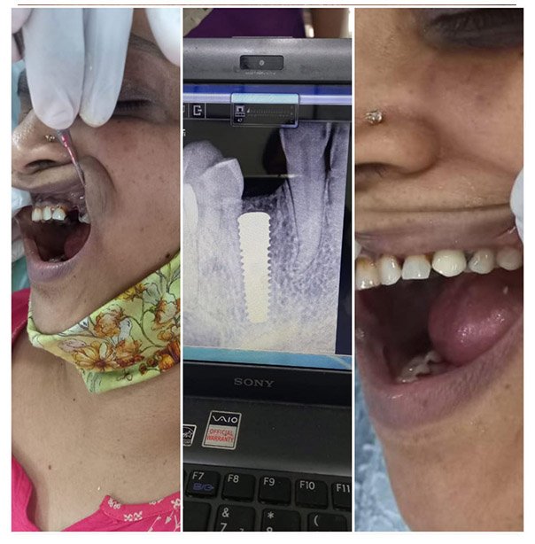 Single tooth dental implant result