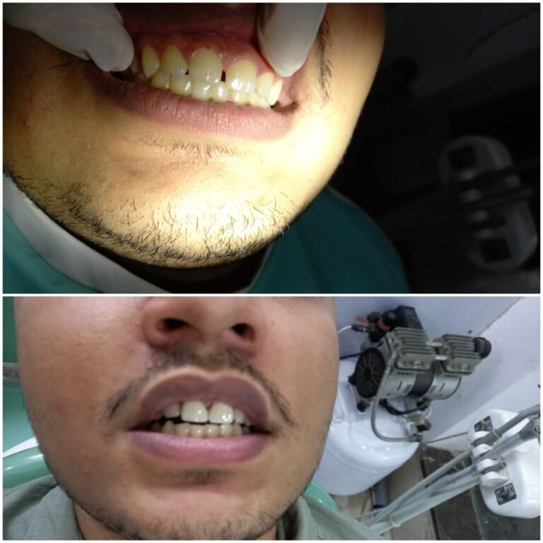 Gap Correction - Dr. Ankita Jindal Poddar