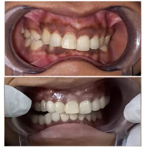 Full Mouth Rehab - Dr. Ankita Jindal
