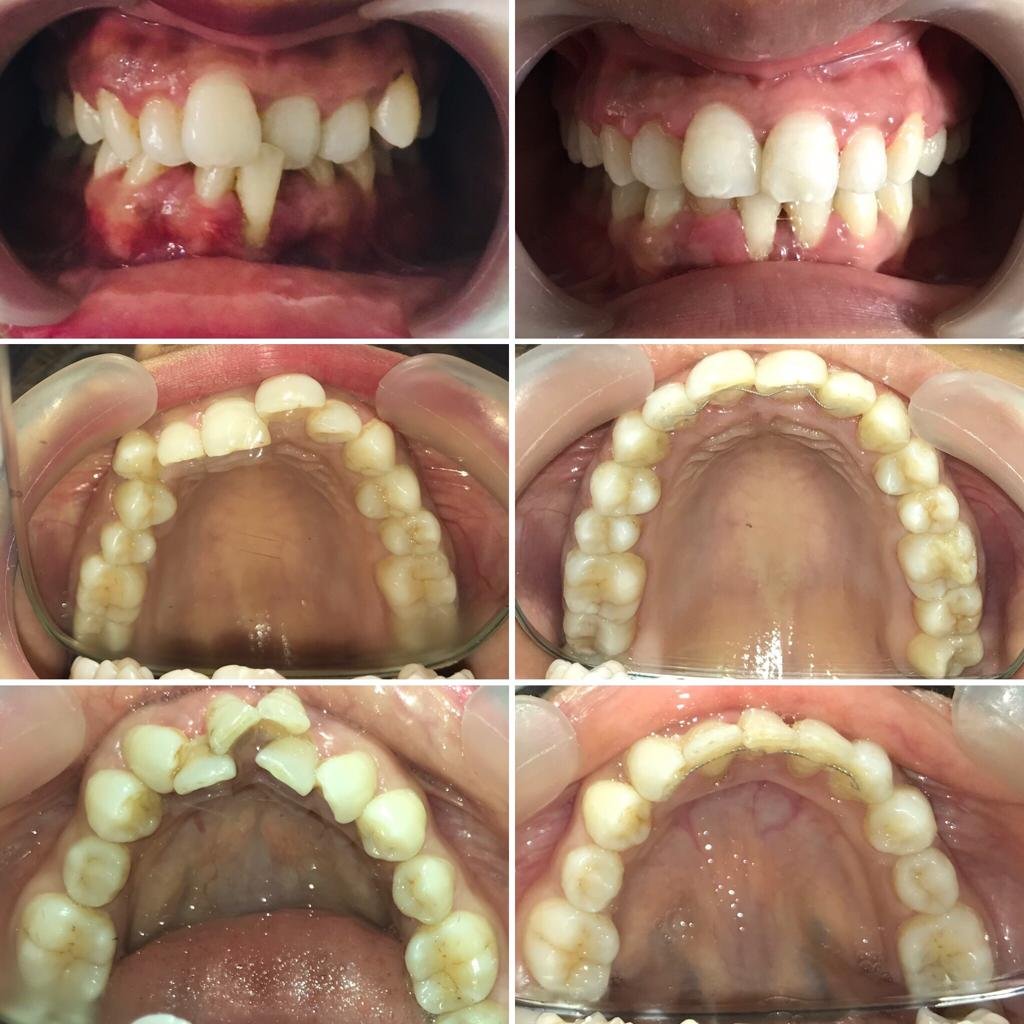 Orthodontic braces treatment result
