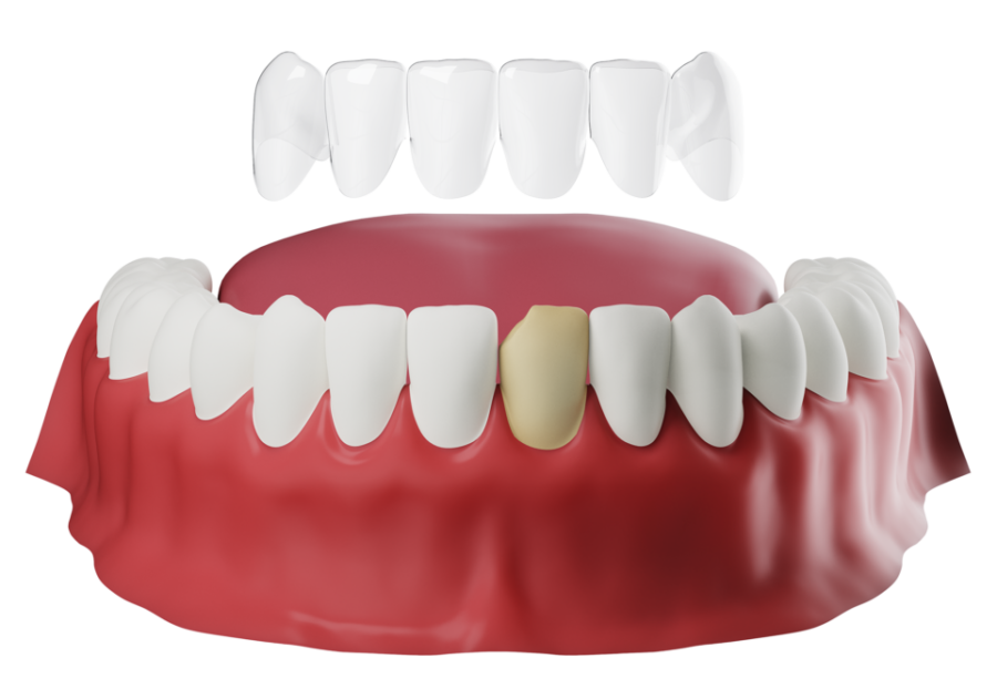 Porcelain Veneers in india