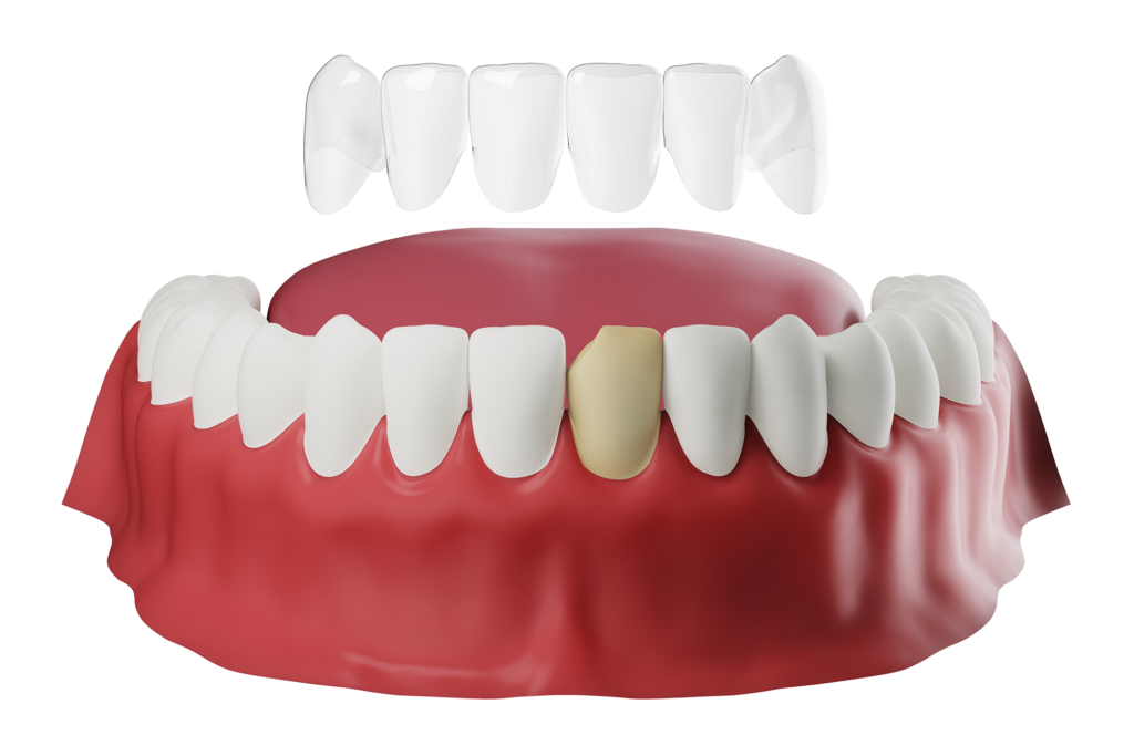 Porcelain Veneers in india