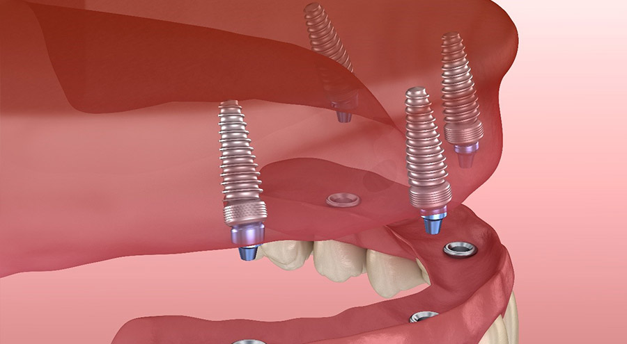 Multiple Dental Implants in Delhi