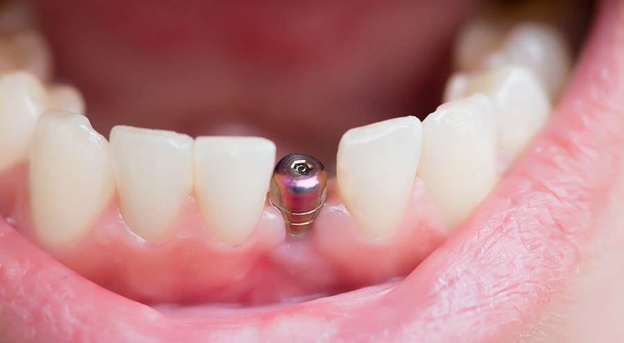 Single Tooth Implants Service in Delhi