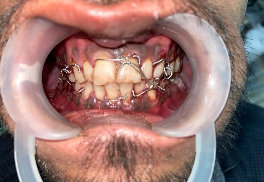 We did intermaxillary fixation for lower jaw(mandibular fracture)I'm trauma cases