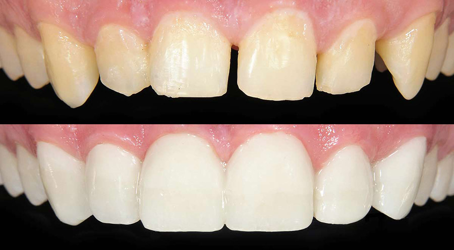 dental-bonding-teeth-reshaping-in-delhi
