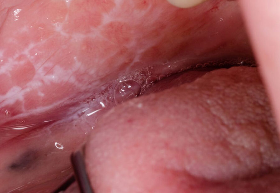 oral litchen planus causes and treatment