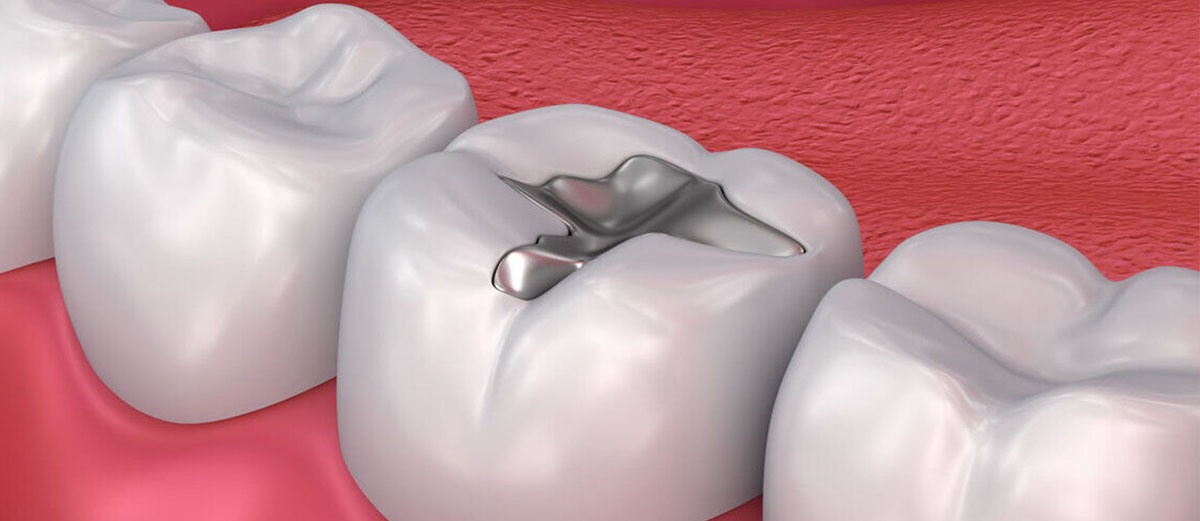 dental-fillings-delhi