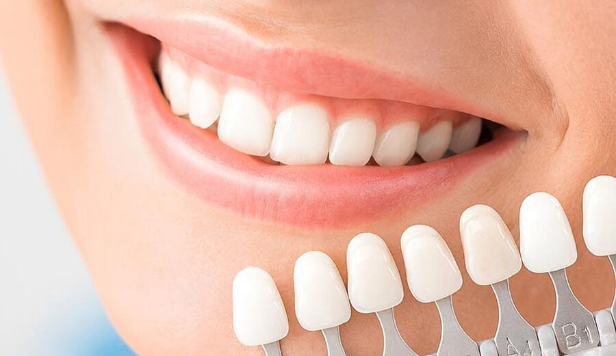 teeth-whitening-cost-in-delhi