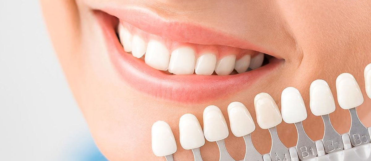 teeth-whitening-cost-in-delhi