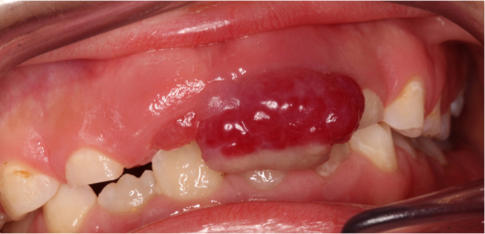 oral pyogenic granuloma