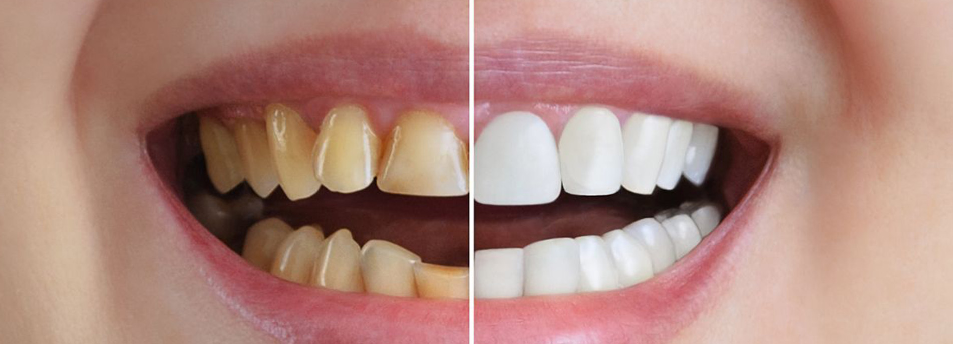 cost of teeth whitening in Delhi 2024 year updated