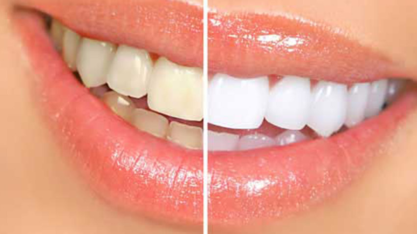teeth whitening in delhi