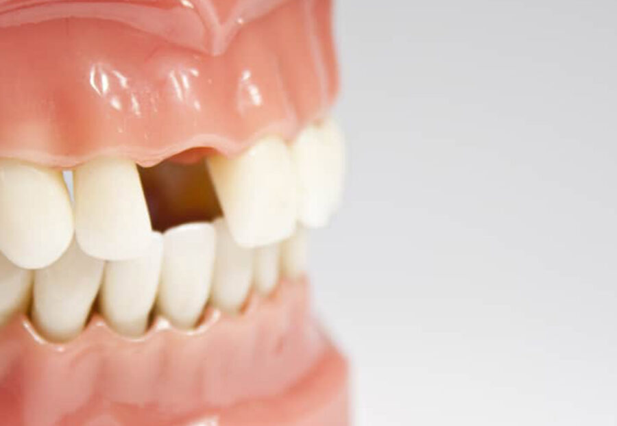 Missing Tooth Replacement