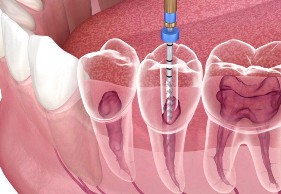 Pinless Single Sitting Root Canal Treatment in Delhi
