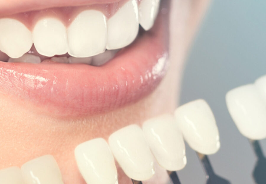Ultrasonic Dental Cleaning in Delhi