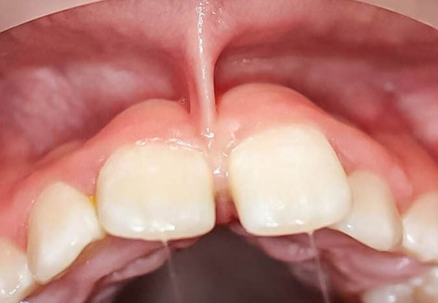 Understanding Frenectomy -A Guide to Oral Health