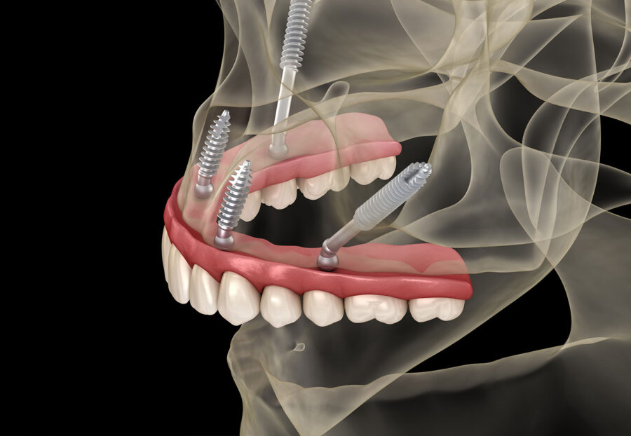 Zygomatic Implants in Delhi- A Revolutionary Solution for Severe Bone Loss