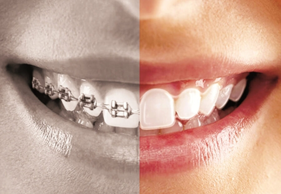Braces vs. Aligners