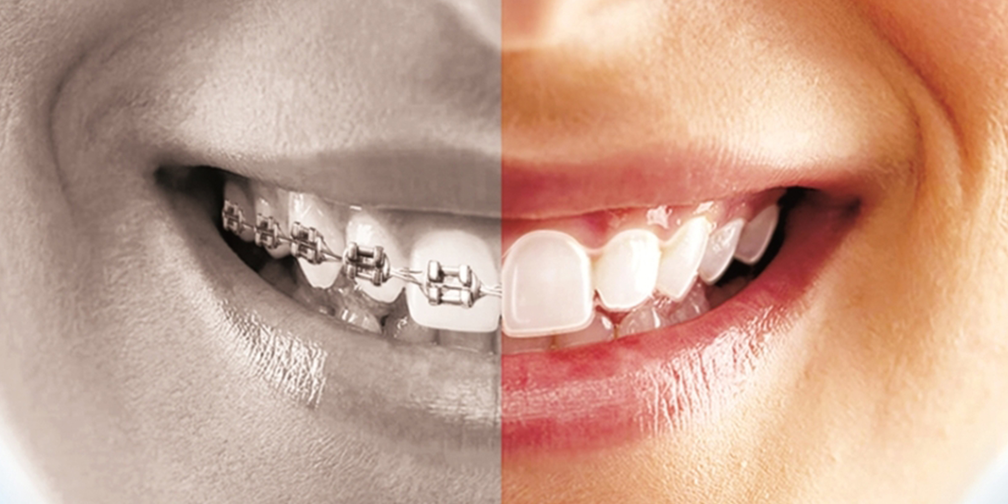 Braces vs. Aligners