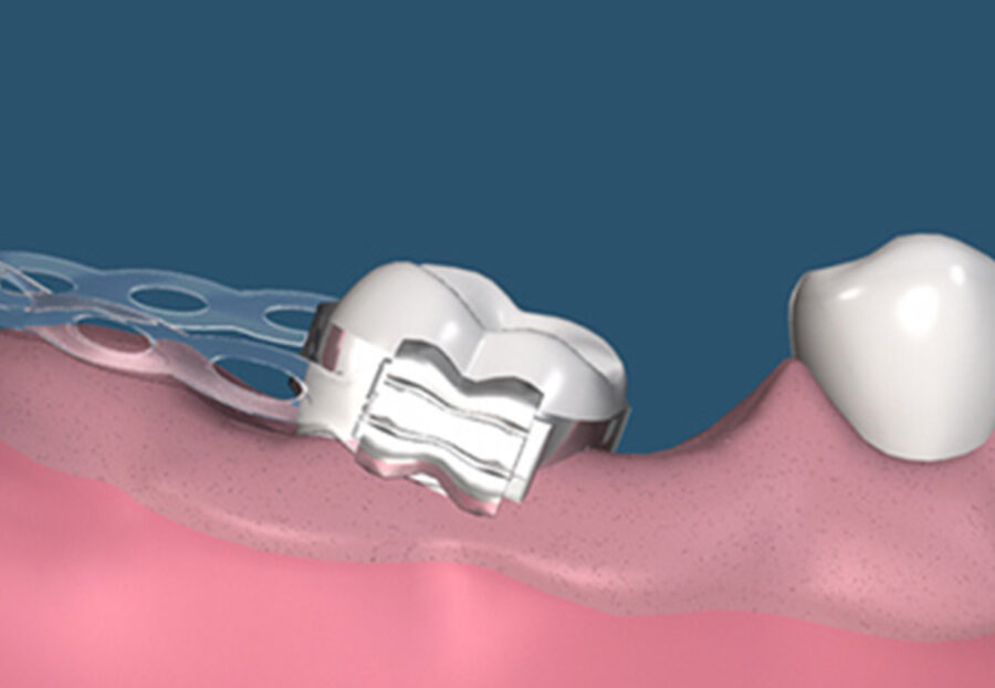 Orthodontic Implants