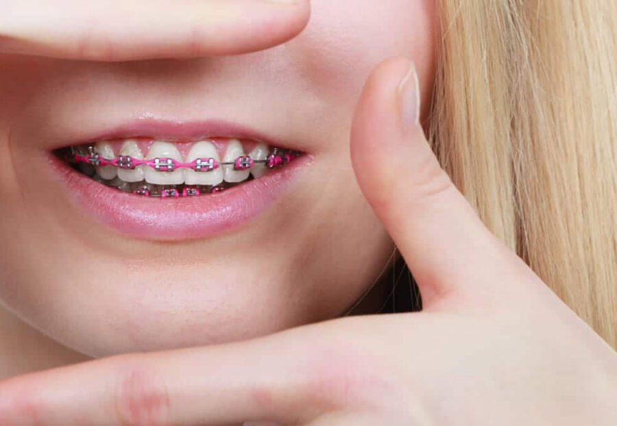 Role of Braces in Correcting an Asymmetrical Jaw