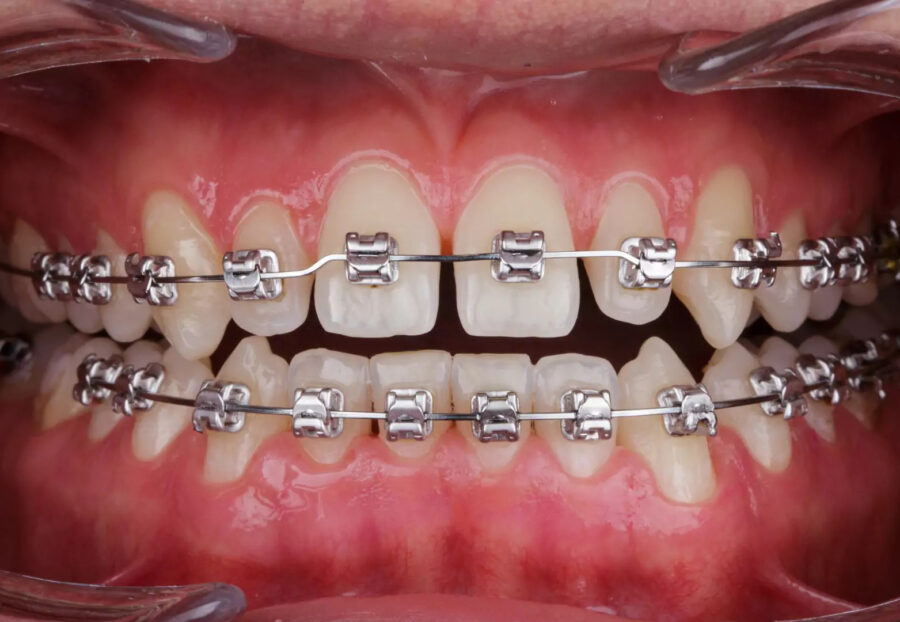 Role of Braces in Crowded Teeth