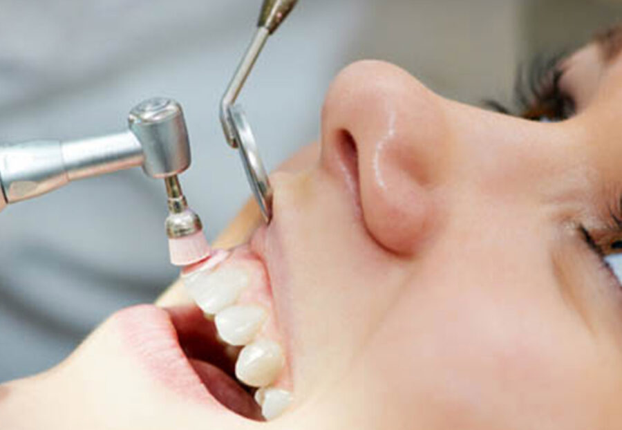 dental-cleaning in north delhi