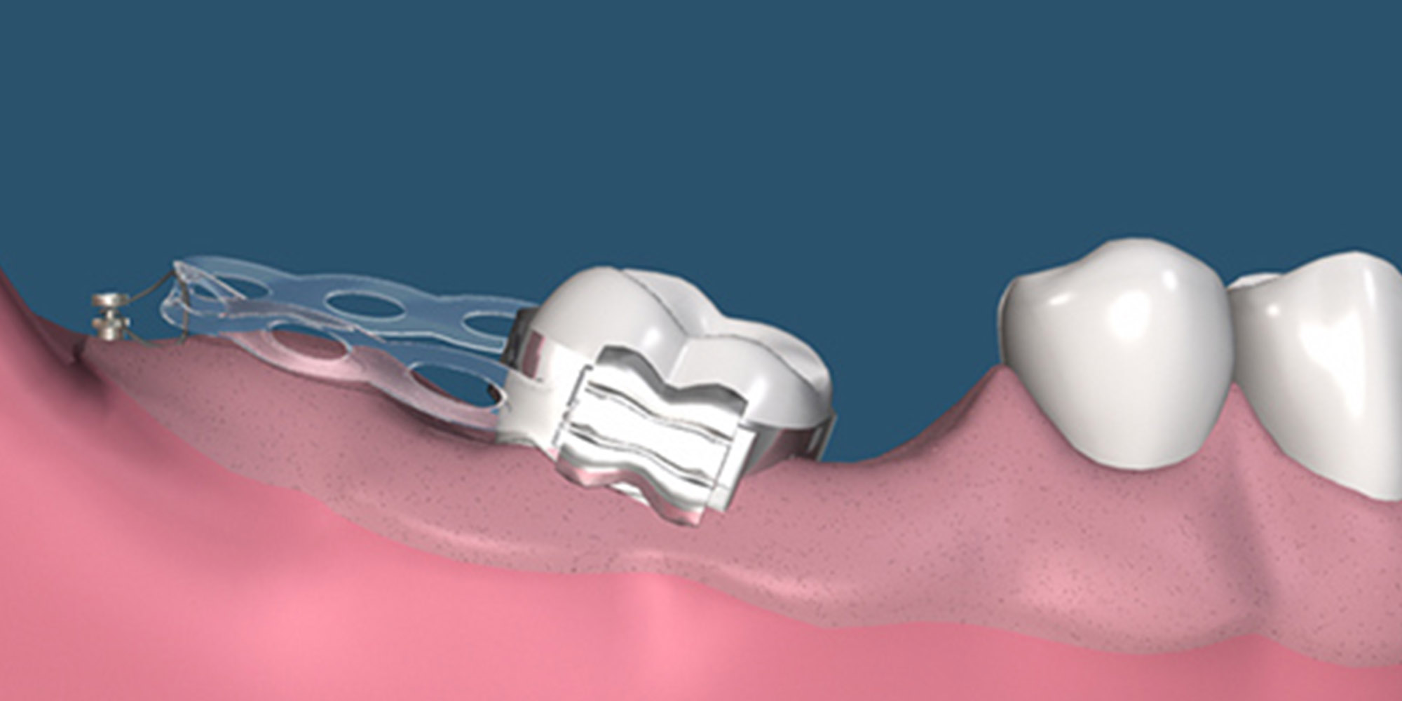 Orthodontic Implants in Delhi