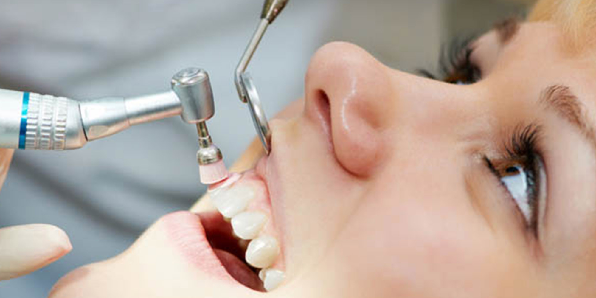 dental-cleaning in north delhi