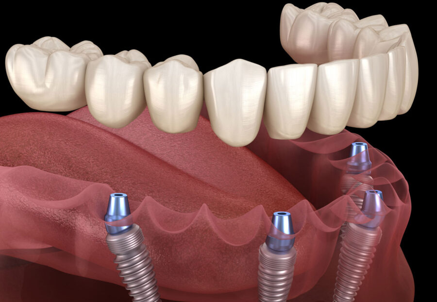 full mouth dental implants in delhi