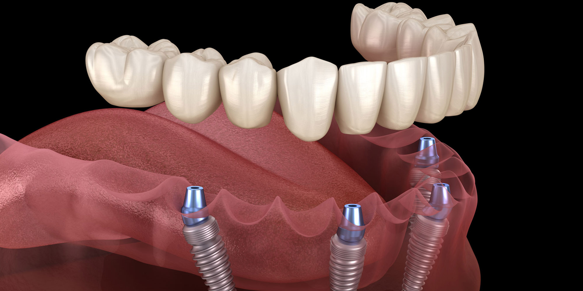 full mouth dental implants in delhi