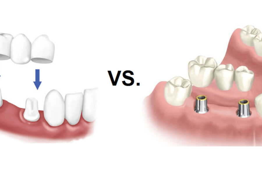 Single Tooth Implant vs. Bridge