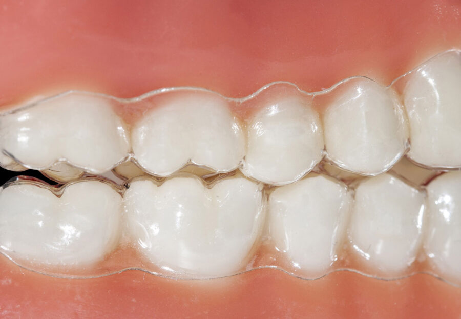 Teeth Grinding (Bruxism)
