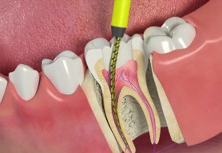 How Much Does a Root Canal Cost