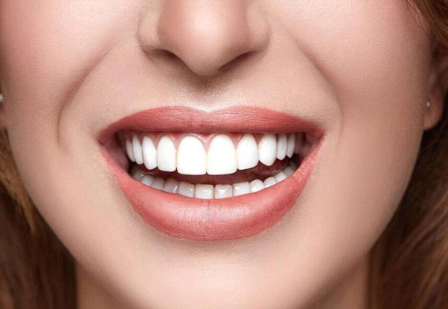 How Smile Makeovers change your confidencde level