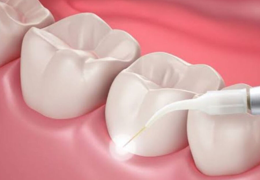 Laser Dentistry