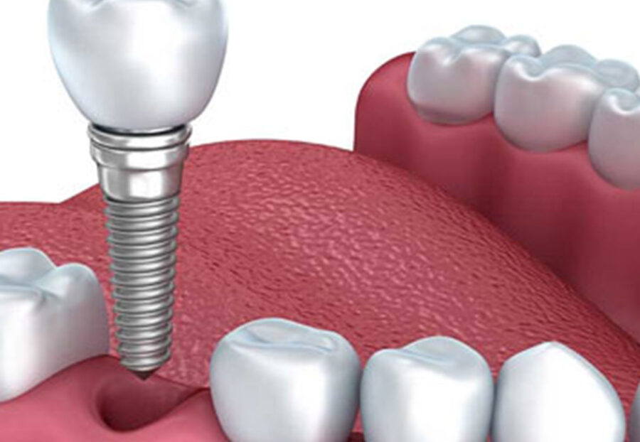 Affordable Dental Implants