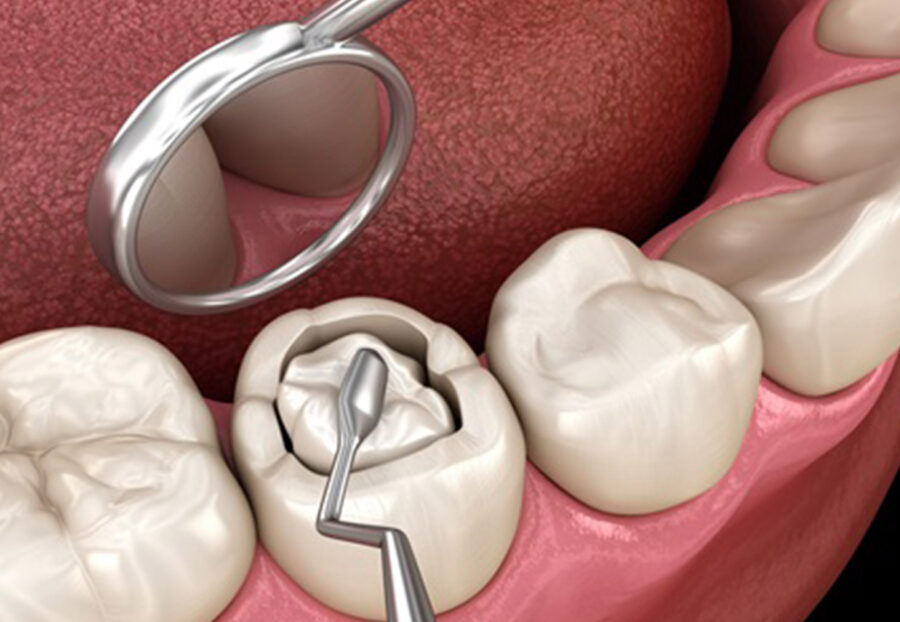 Dental Tooth Filling