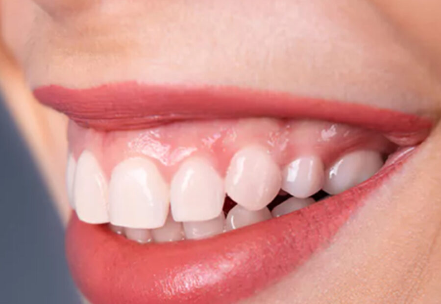 Gummy Smile Correction