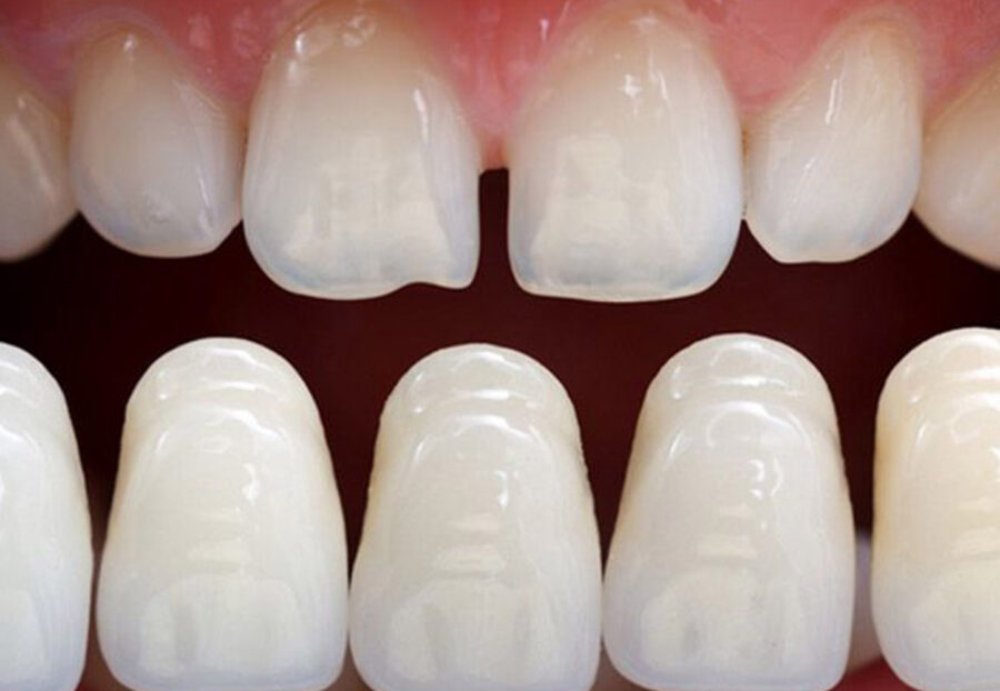 What to Know Before Getting Dental Veneers