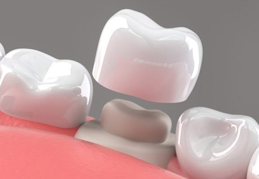 Paediatric Crowns in Delhi